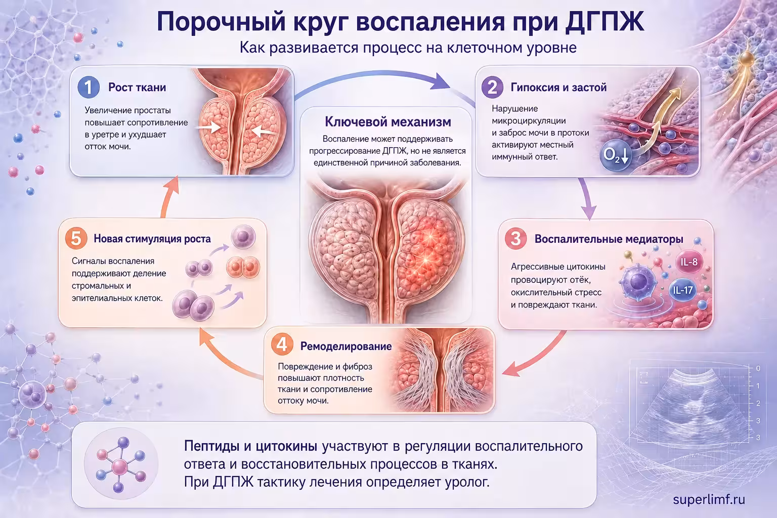 Инфографика процесса хронического воспаления при ДГПЖ.